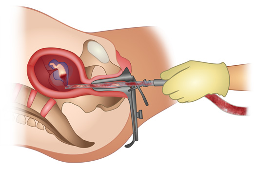 Surgical abortion